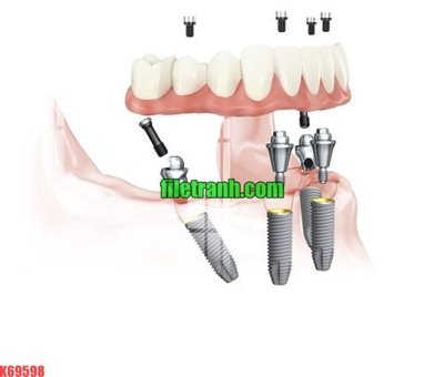 File in mica File gốc in tranh nền tường tổng hợp K69598 (bản gốc) làm vách ngăn